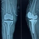 Best Knee Arthroscopy Surgery in dindugul