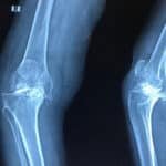 Joint Replacement Surgery in madurai
